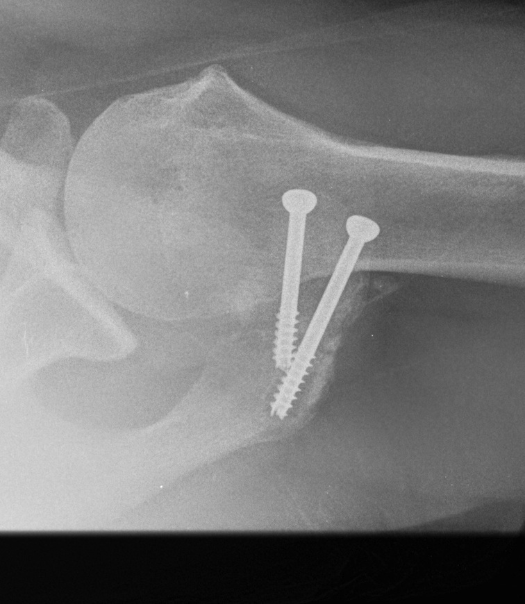 Os Acromionale Nonunion 3